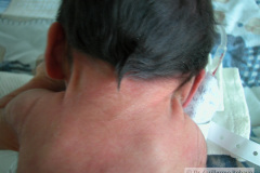 pterygium-colli-cuello-alado-2003-000