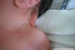pterygium-colli-cuello-alado-2003-003