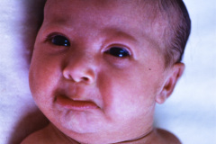 pterygium-colli-cuello-alado-000