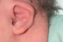 pterygium-colli-discapacidad-mental-2007-000