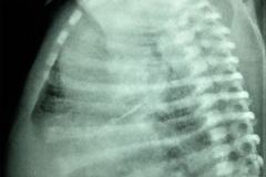 pulmon-de-choque-shock-neonatal-000