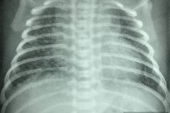 pulmon-de-choque-shock-neonatal-001