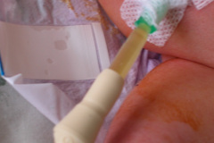 puncion-drenaje-ascitis-neonatal-000