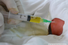 puncion-drenaje-ascitis-neonatal-002
