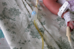 puncion-drenaje-ascitis-neonatal-003