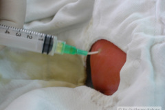 puncion-drenaje-ascitis-neonatal-007