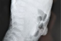 puntos-contencion-pared-abdominal-osteopenia-generalizada-ileostomia-2005-004