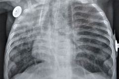 puntos-contencion-pared-abdominal-osteopenia-generalizada-ileostomia-2005-005