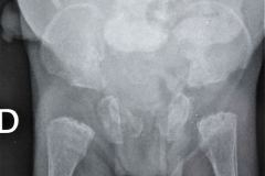 puntos-contencion-pared-abdominal-osteopenia-generalizada-ileostomia-2005-006
