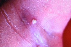 pustula-axilar-000