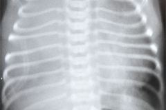 quilotorax-postop-de-atresia-esofago-001
