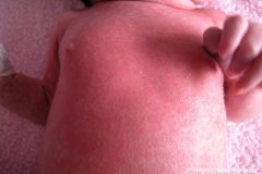 quinta-enfermedad-parvovirosis-b19-2009-000