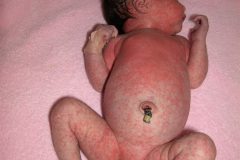 quinta-enfermedad-parvovirosis-b19-2009-003