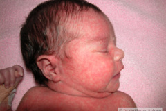 quinta-enfermedad-parvovirosis-b19-2009-005