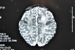 quiste-cerebral-isquemico-y-hemorragico-hemorragia-sub-ependimaria-tac-rnm-1997-009