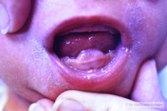 quiste-mucoso-encia-000