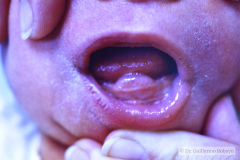 quiste-mucoso-encia-001