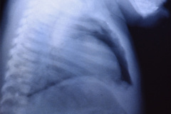 quiste-pericardico-pre-y-postop-003