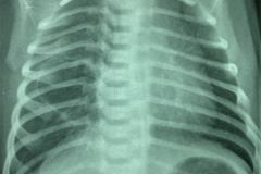 quiste-pulmonar-8d-tac-2005-000