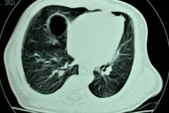 quiste-pulmonar-8d-tac-2005-004