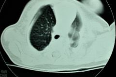 quiste-pulmonar-8d-tac-2005-011