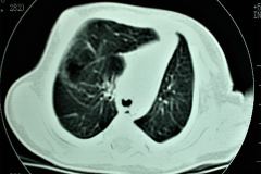 quiste-pulmonar-8d-tac-2005-012