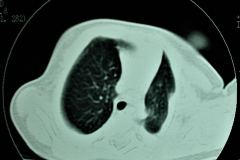 quiste-pulmonar-8d-tac-2005-013