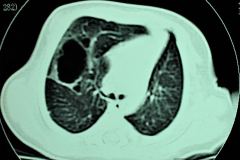 quiste-pulmonar-8d-tac-2005-014