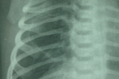 quiste-pulmonar-desaturacion-8d-2005-003