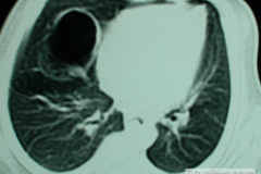 quiste-pulmonar-desaturacion-8d-2005-004