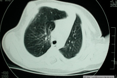 quiste-pulmonar-desaturacion-8d-2005-008