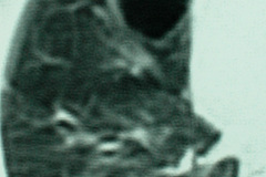 quiste-pulmonar-desaturacion-8d-2005-011