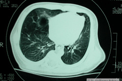quiste-pulmonar-desaturacion-8d-2005-013