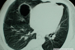 quiste-pulmonar-desaturacion-8d-2005-015