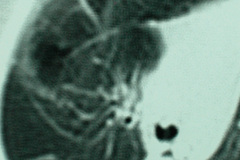 quiste-pulmonar-desaturacion-8d-2005-016
