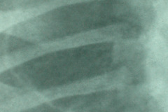 quiste-pulmonar-desaturacion-8d-2005-017