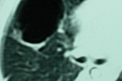 quiste-pulmonar-desaturacion-8d-2005-019