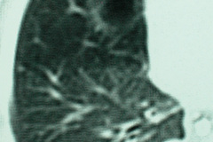quiste-pulmonar-desaturacion-8d-2005-020
