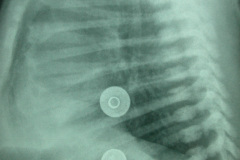 quiste-pulmonar-desaturacion-8d-2005-021