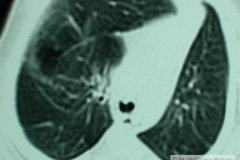 quiste-pulmonar-desaturacion-8d-2005-022