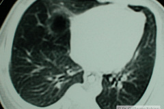 quiste-pulmonar-desaturacion-8d-2005-023