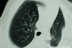 quiste-pulmonar-desaturacion-8d-2005-027
