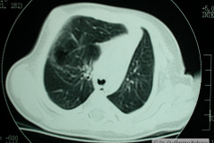 quiste-pulmonar-desaturacion-8d-2005-035