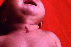 quiste-y-fistula-tiroglosos-1992-001
