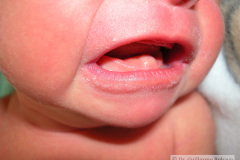 quistes-dentales-2009_08_24-000