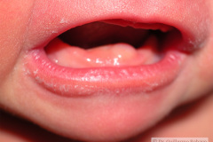 quistes-dentales-2009_08_24-002