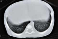 quistes-mediastinales-tac-gamagrafia-perfusion-ventilacion-1995-009