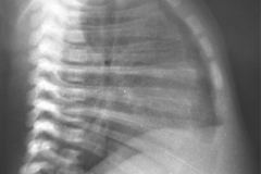 quistes-mediastinales-tac-gamagrafia-perfusion-ventilacion-1995-014
