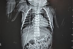 quistes-mediastinales-tac-gamagrafia-perfusion-ventilacion-1995-015