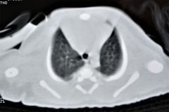 quistes-mediastinales-tac-gamagrafia-perfusion-ventilacion-1995-020
